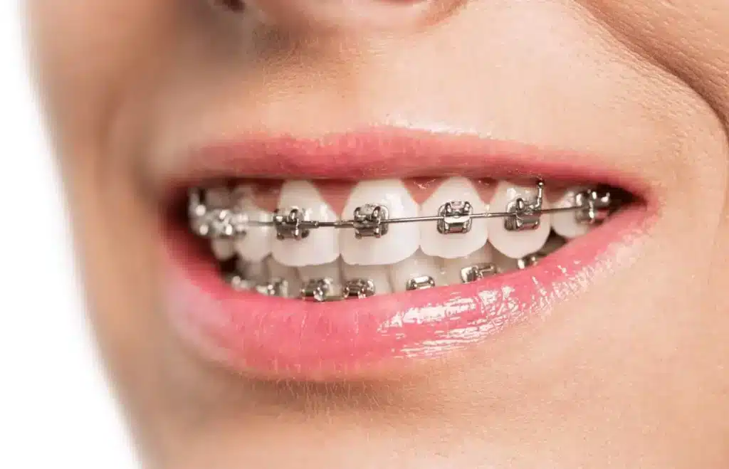 Braces To Align Teeth