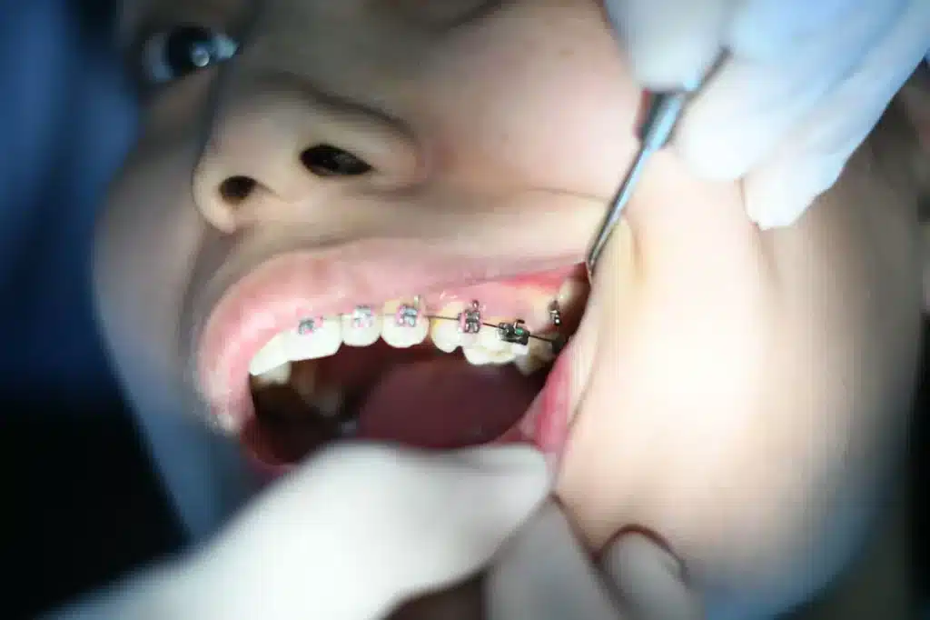 Braces to Fix Gap in Teeth