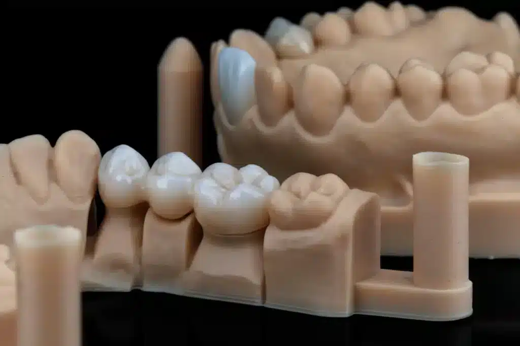 Dental Bridges on a Model