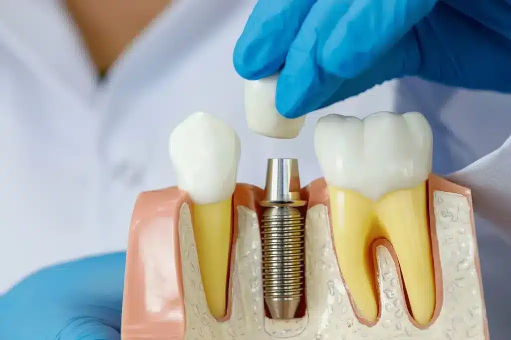 Dental Implant Costs Across the World