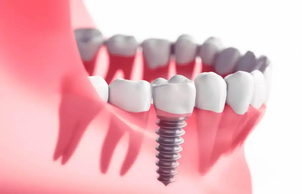 Dental Implants Treatment