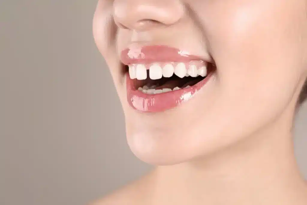 How to Fix Gap Between Your Teeth