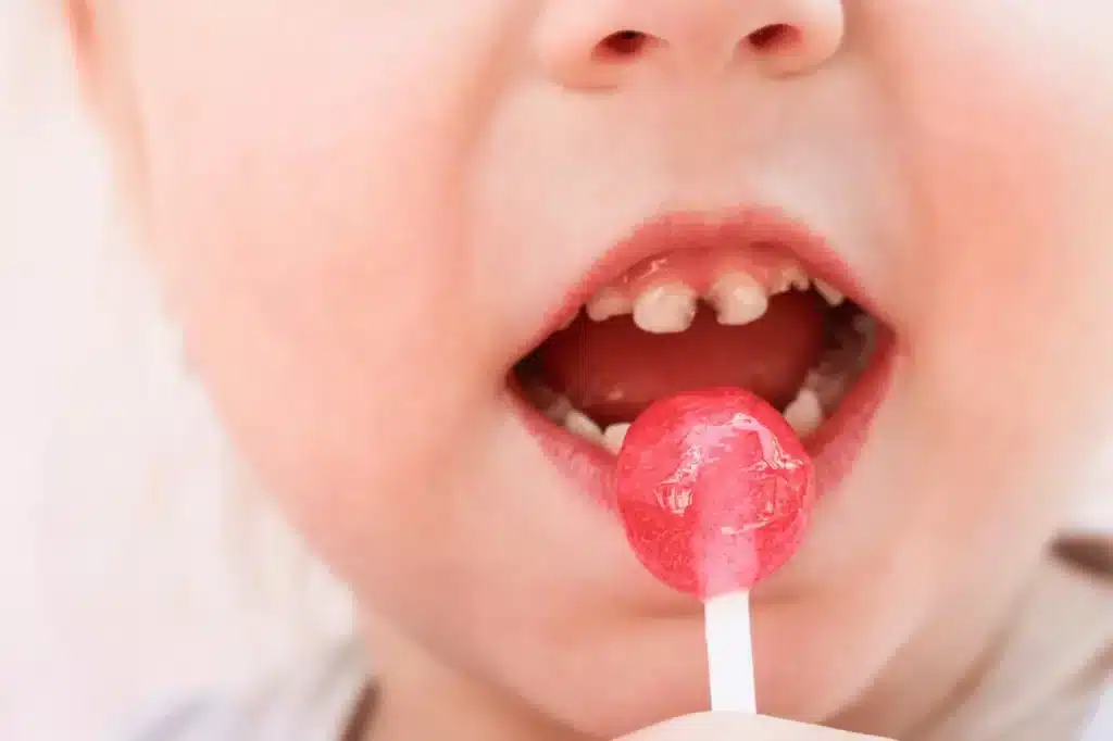 Sugar Causing Tooth Decay