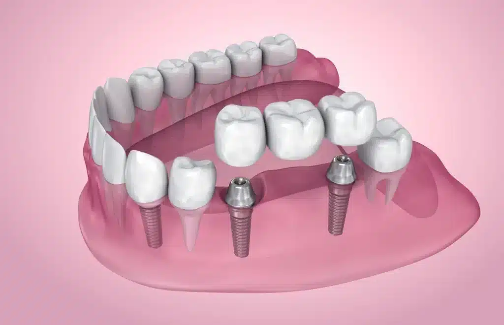 3D Dentures Model