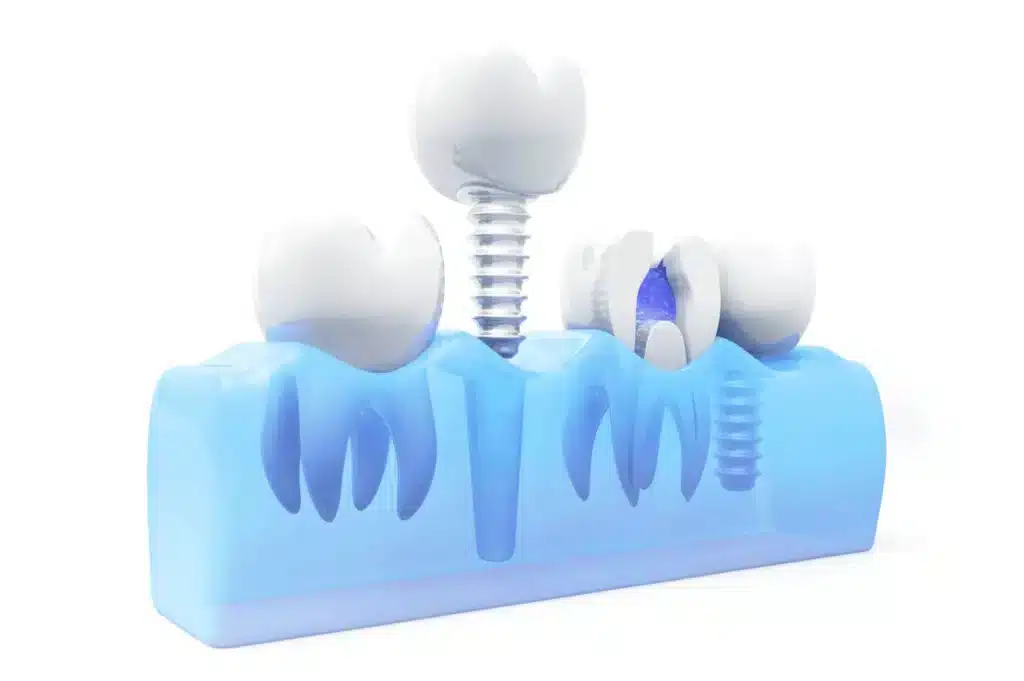 3D Model of an Implant