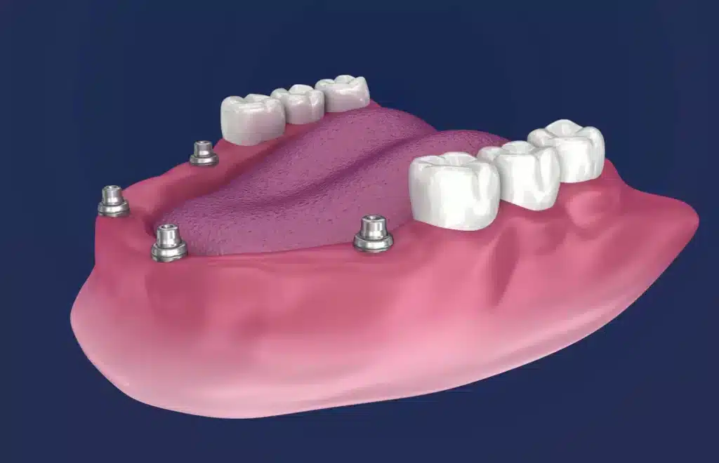 3d All on 4 Implant Model