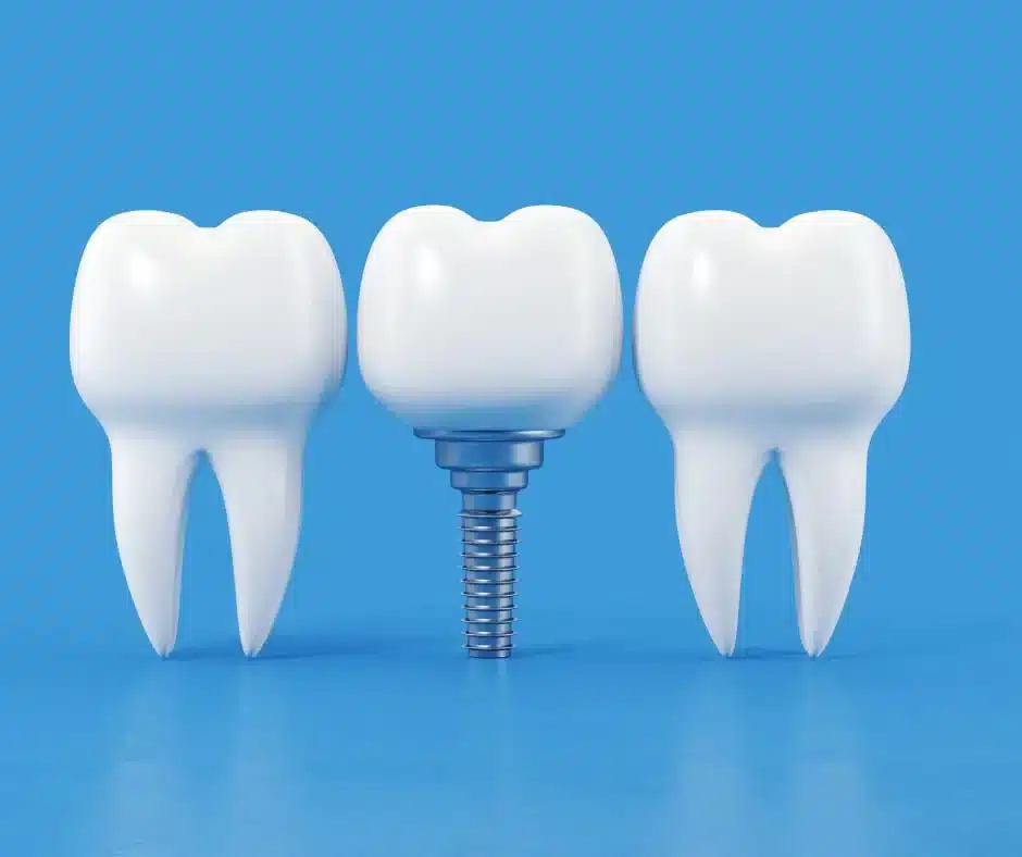 A Dental Implant