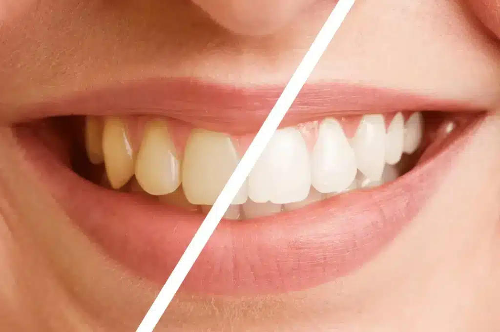 Affordable Teeth Whitening Abroad