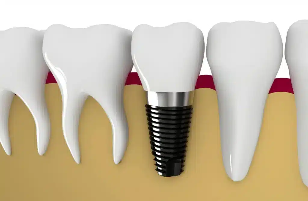 Crown Placement on Implant