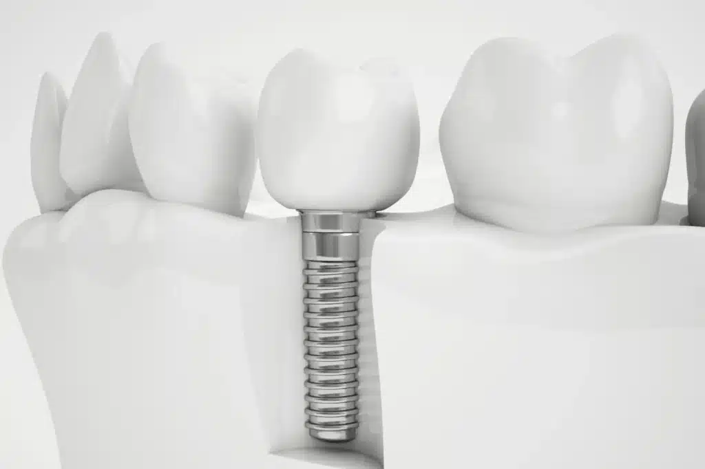 Dental Implant on a Model