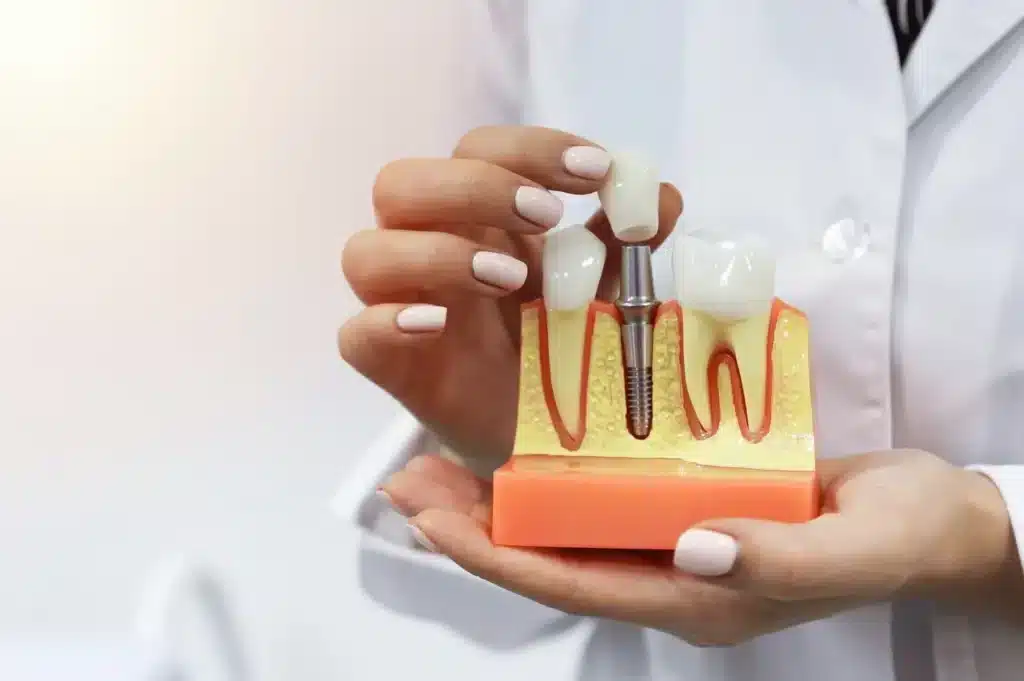 Dentist Holding an Implant Model