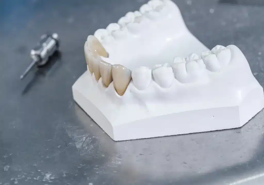 Tooth Implant Model