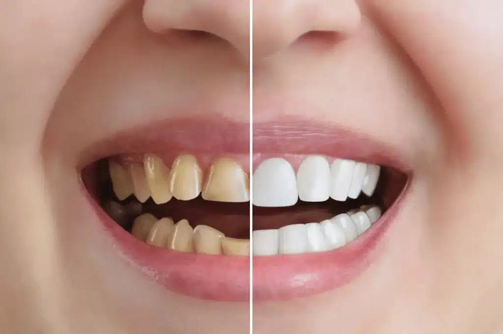 Cost of Teeth Whitening in the UK