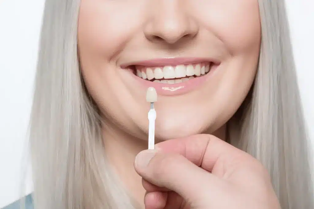 Cost of Veneers in the UK