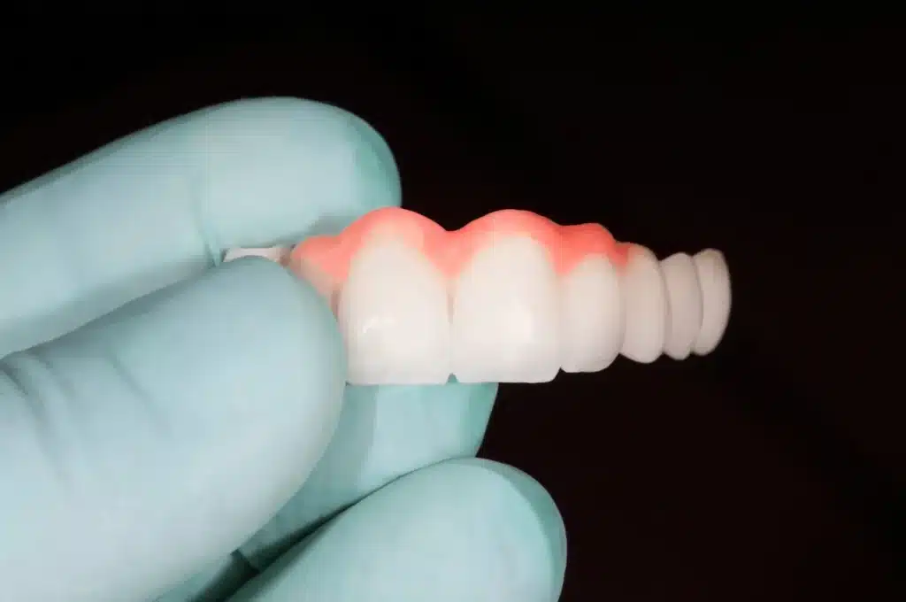 Dental Bridge