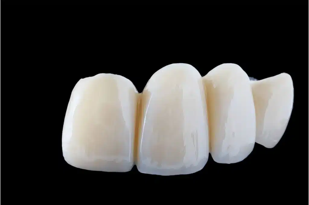 Dental Bridges