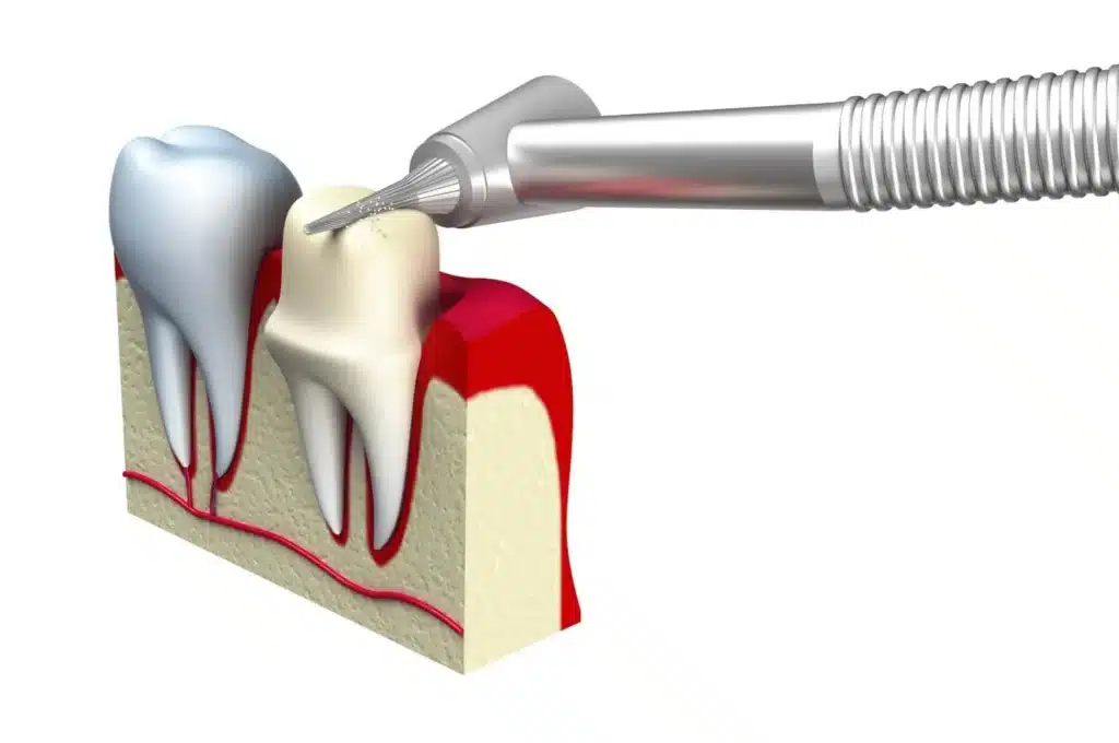 Dental Crowns Process