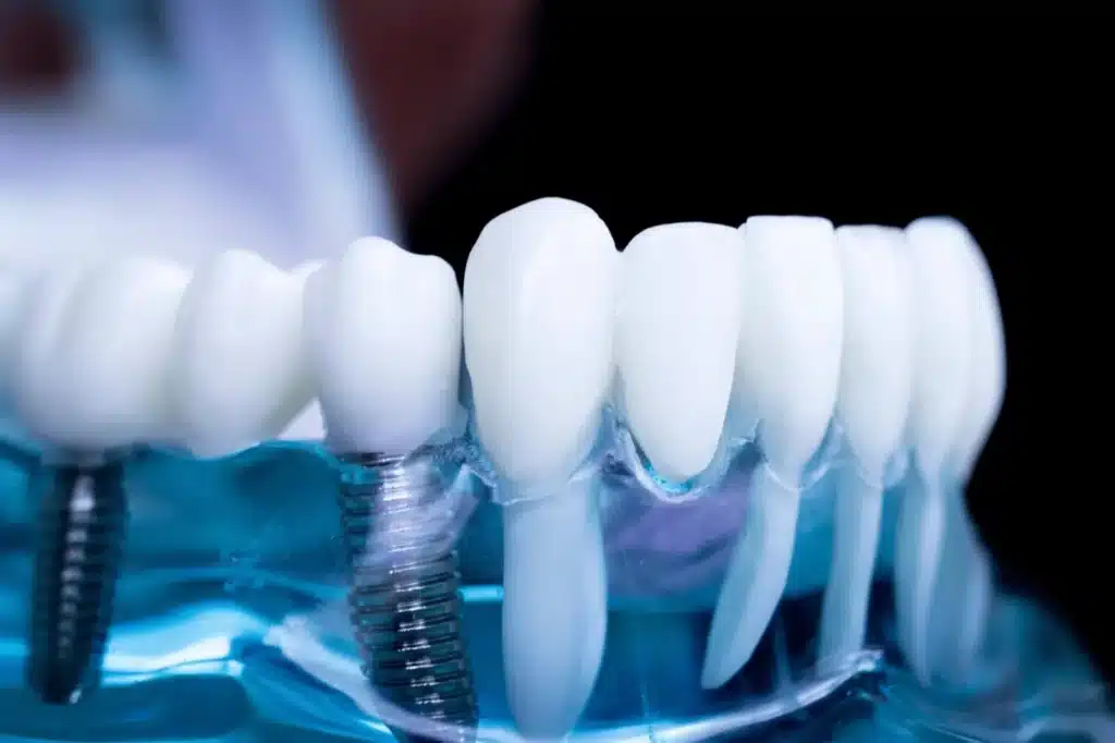 Dental Implants