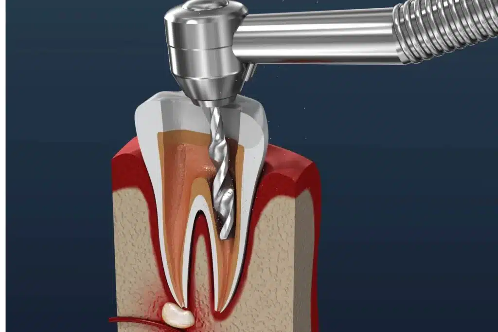 Root Canal Treatment Cost in the UK