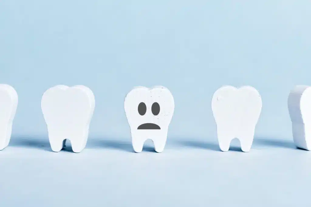 Tooth Decay Due to Poor Oral Hygiene