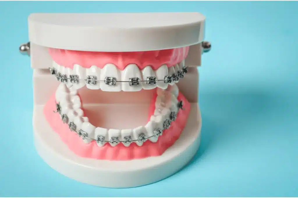 Cost of Braces Abroad