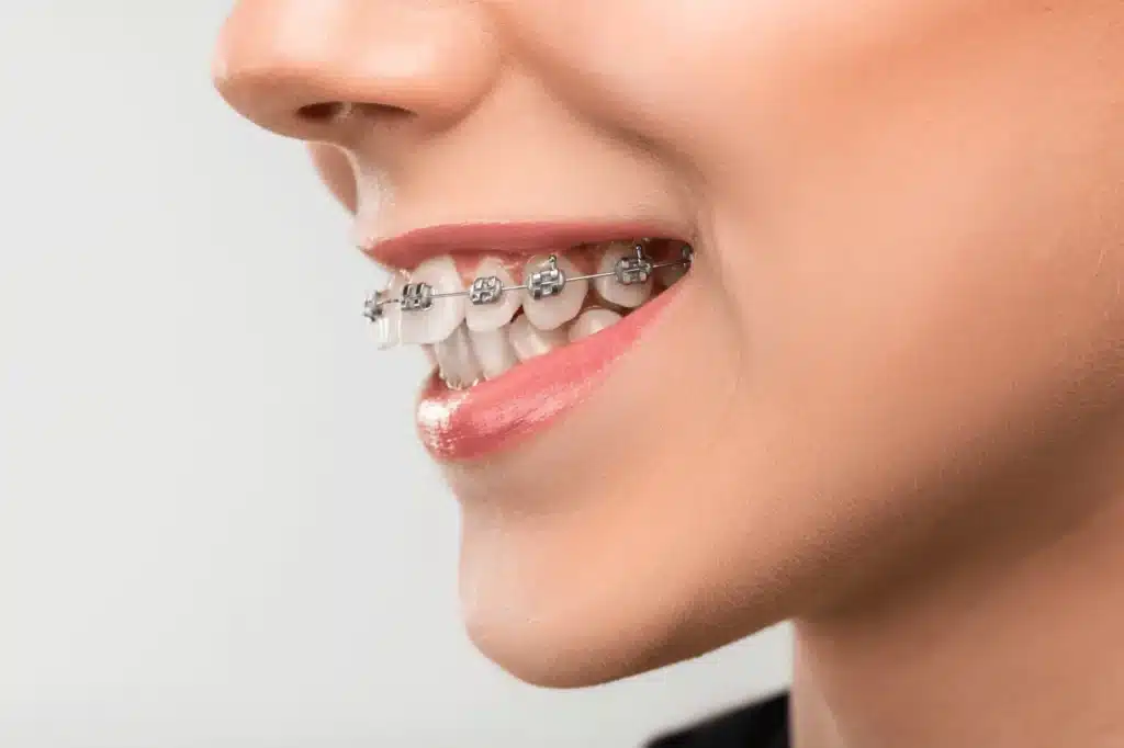 Cost of Braces in Turkey