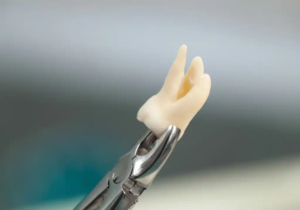 Cost of Wisdom Tooth Extraction in Turkey