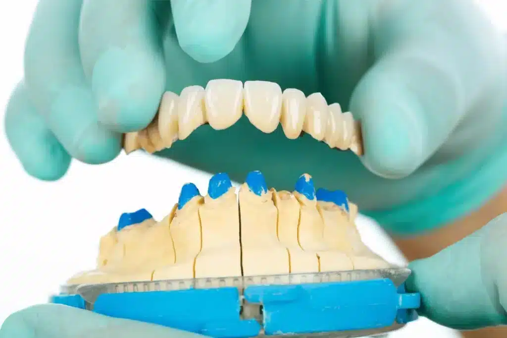 Dental Crowns and Bridges