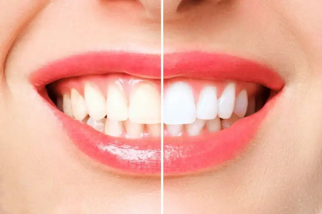 Foods That Naturally Whiten Teeth