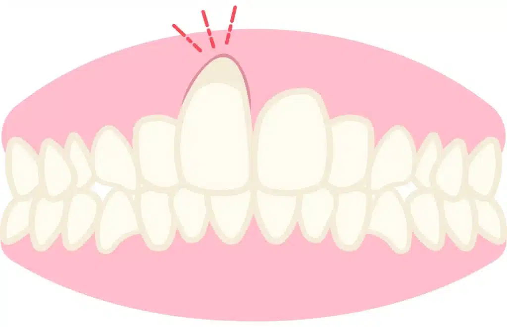 Gum Recession Due To Smoking