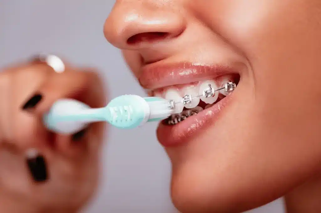 How to Brush Teeth With Braces