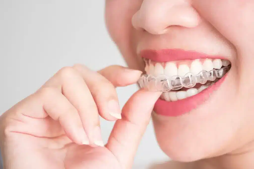 Invisalign are Removeable