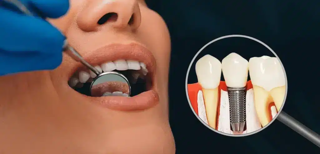 Long-Lasting Dental Implants