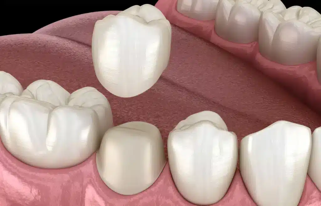 Placing Crown on Tooth