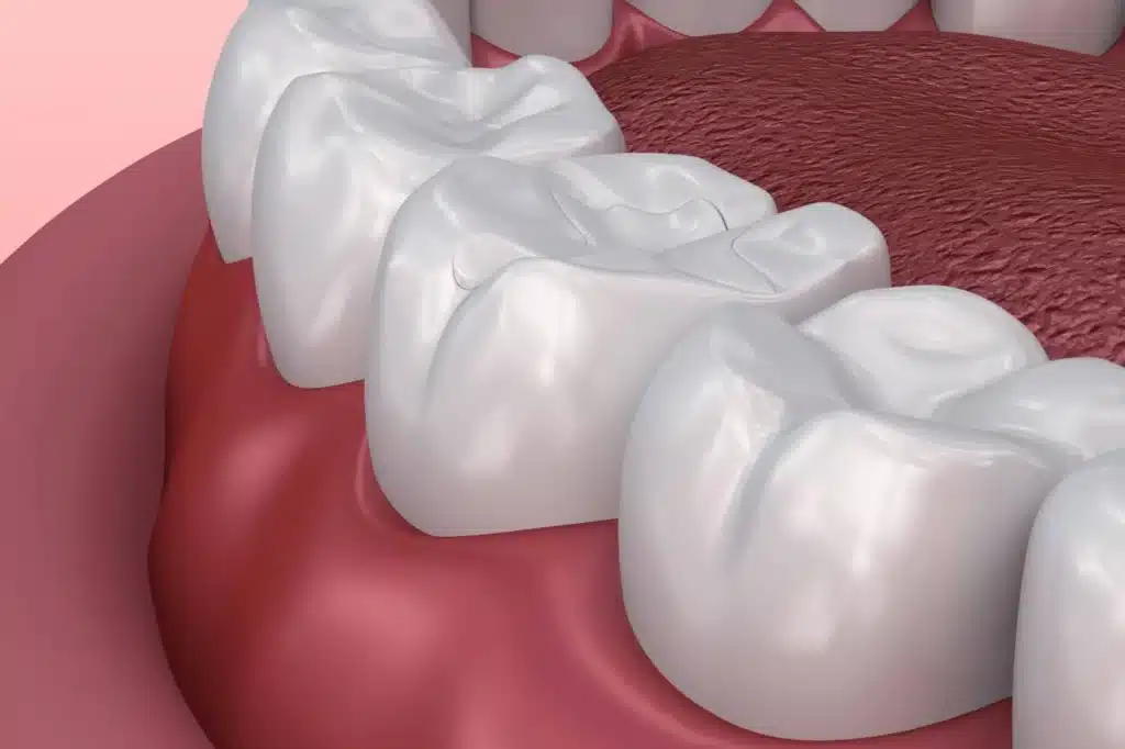 Sealants To Prevent Enamel