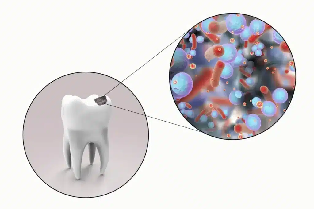 Dental X-rays locate hidden cavities